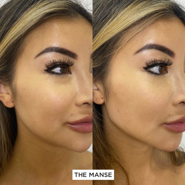 Jawline treatment before and after