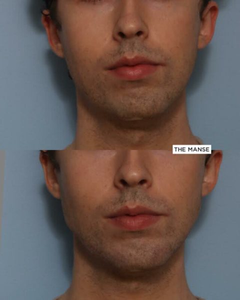 Jawline treatment male subtle before and after