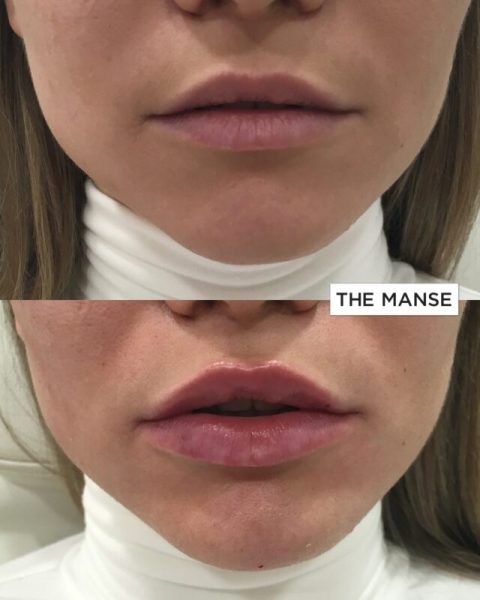 Keyhole lips