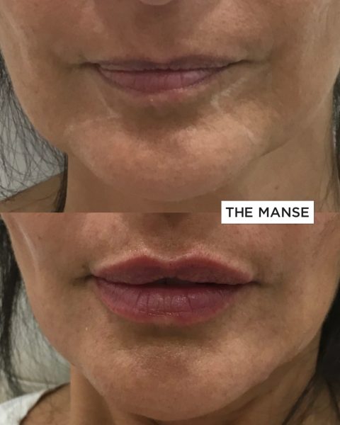 Lip lines treatment before and after