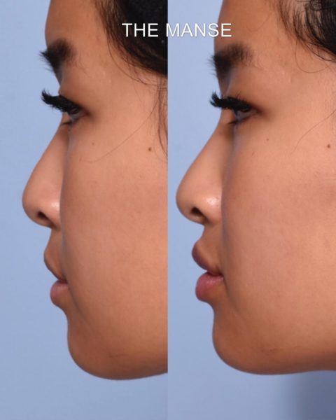 Lip profile (side view) before and after