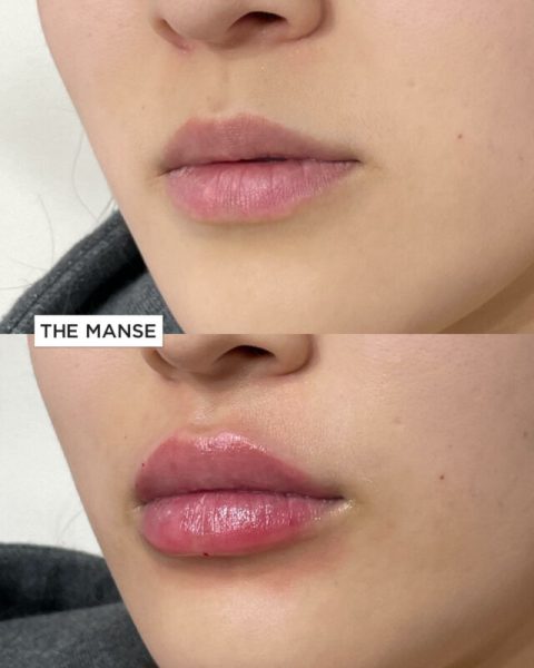 Lip treatment