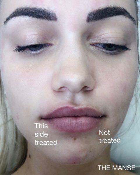 Lip treatment