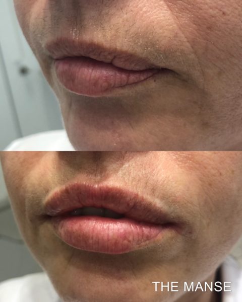 Lip treatment before and after