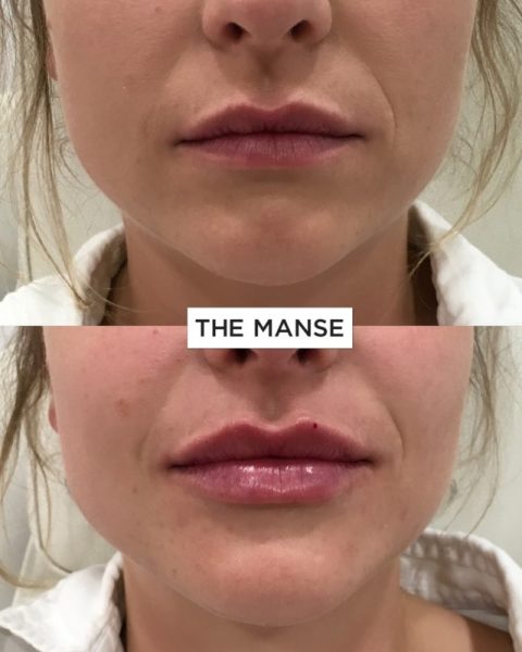 Lips before and after