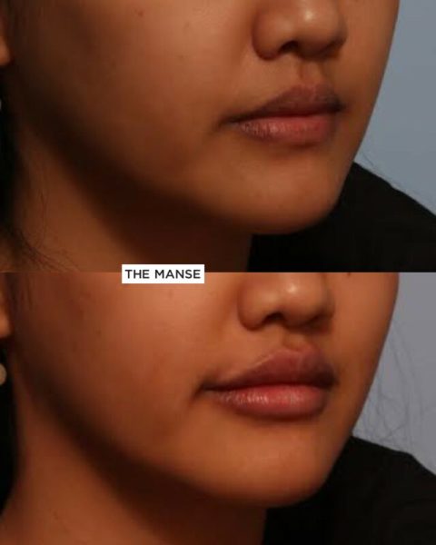 Lips before and after