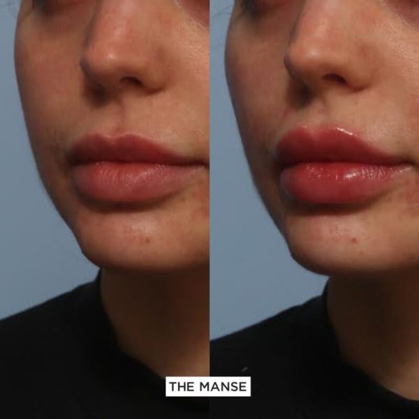 Lips before and after