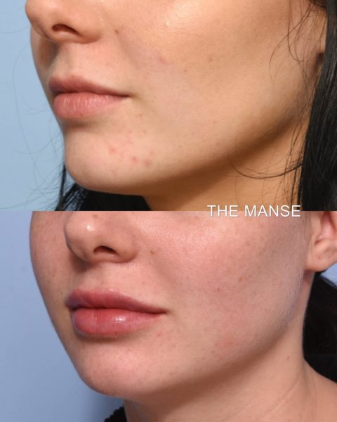 Lips before and after