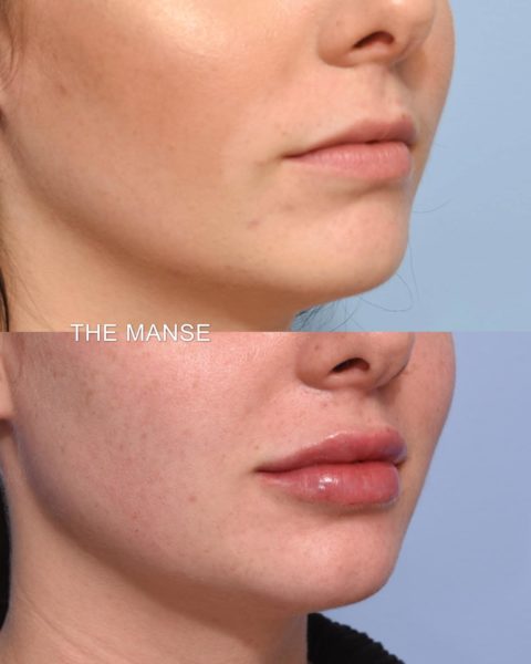 Lips before and after