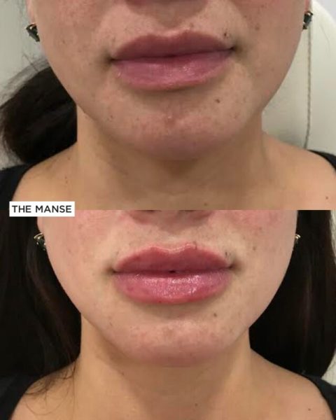 Lips before and after