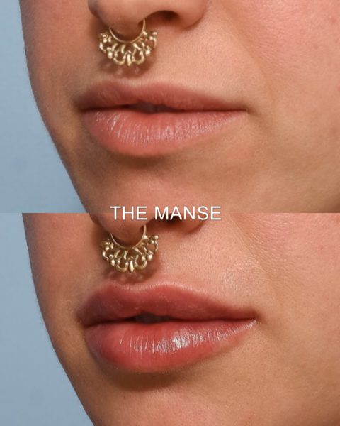 Lips before and after