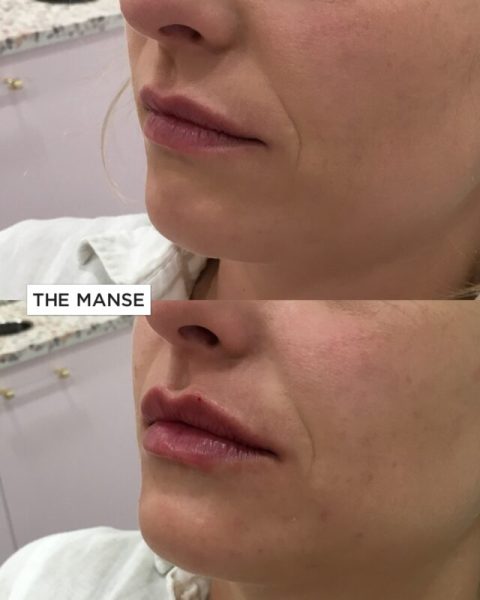 Lips for beautifying