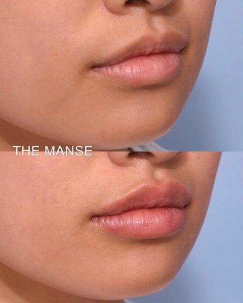 Lips subtle
