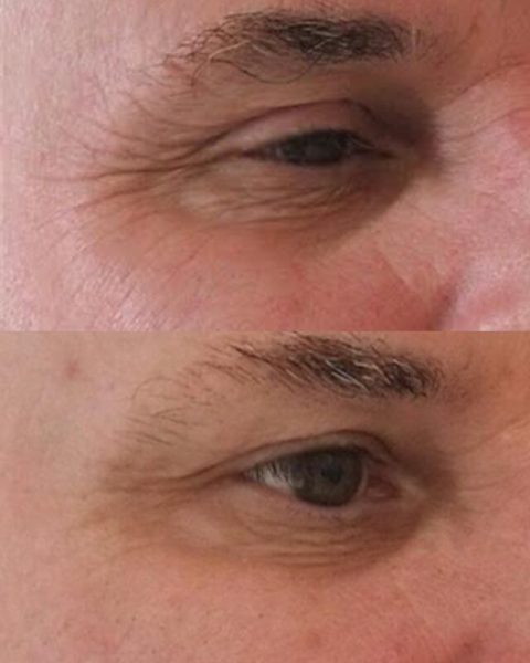 Male eyes before and after subtle treatment