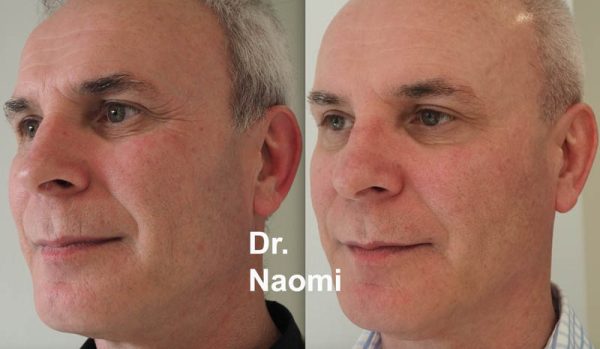 Male treatments for "tired" appearance