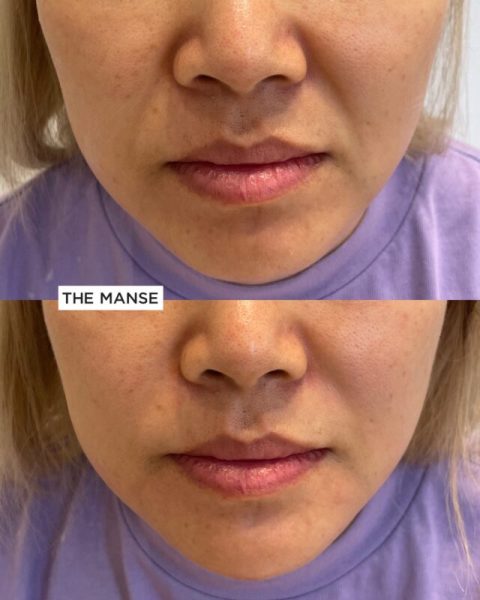 Nasolabial fold treatment