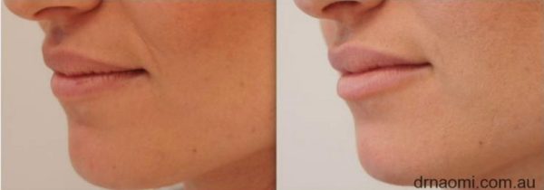 Nasolabial fold treatment before and after (patient also had lower lips)