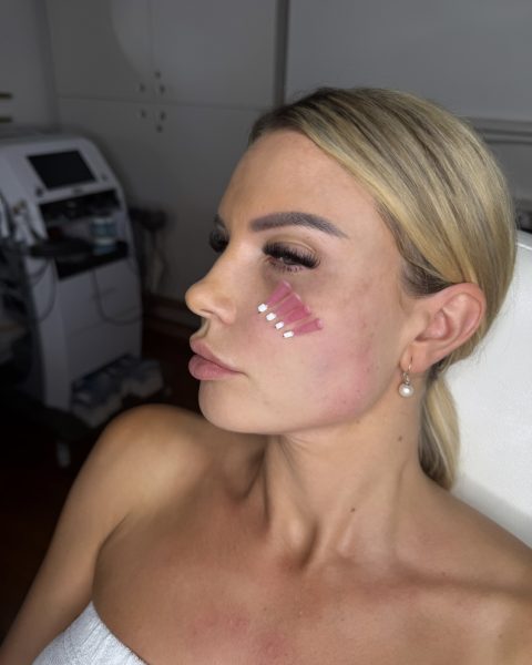 Nasolabial fold treatment