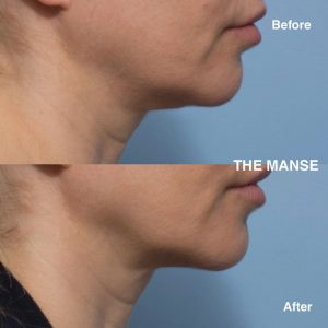 Neck fat dissolving 50 year old 1 treatment