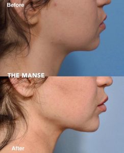 Neck fat dissolving and other treatments
