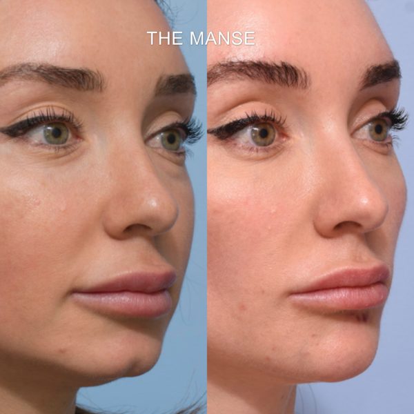 Non-Surgical Facelift