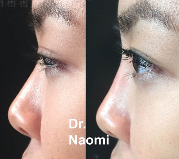 Nose bridge treatment