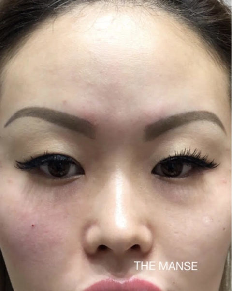 One side front cheek treated and the other untreated, which has an impact on the tear troughs