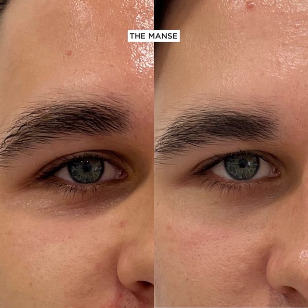 PRP before and after