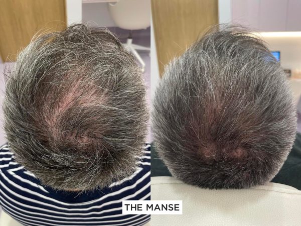PRP hair growth before and after