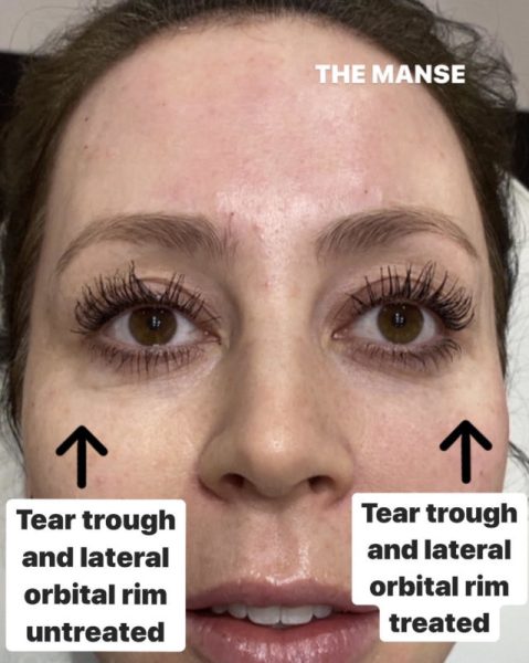 Patient after one side treated