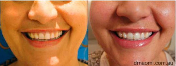 Patient didn't like that her "lips disappeared when smiling".