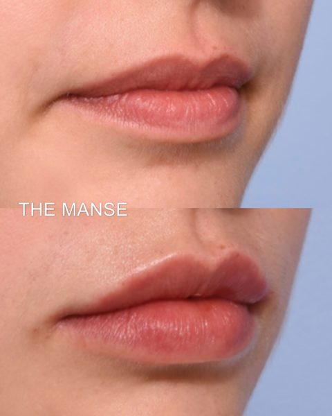 Patient wanted her downturned mouth to look upgoing.