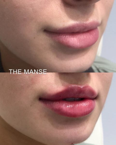 Patient wanted improvement in her Cupids Bow 