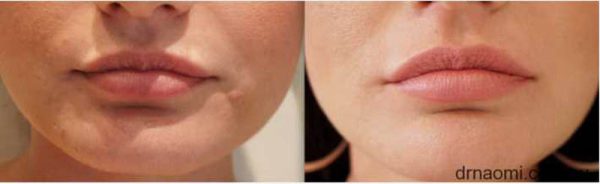 Before and after lip treatment