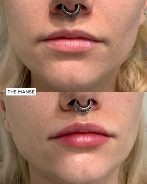 Subtle lip changes