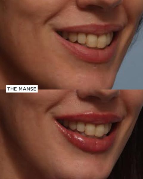Subtle lips smiling before and after