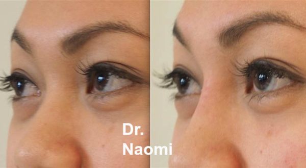 Subtle nose bridge lifting