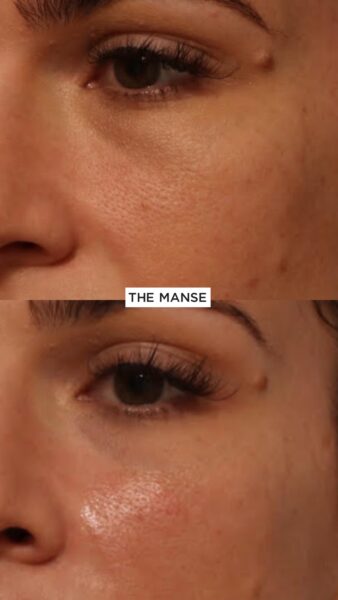 Tear trough subtle result