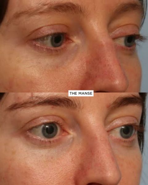 Tear trough treatment