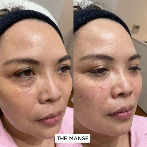 Tear trough treatment