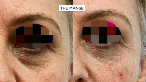 Tear trough treatment with patient with skin laxity