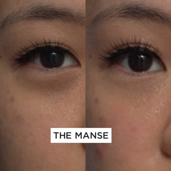 Tear trough treatments