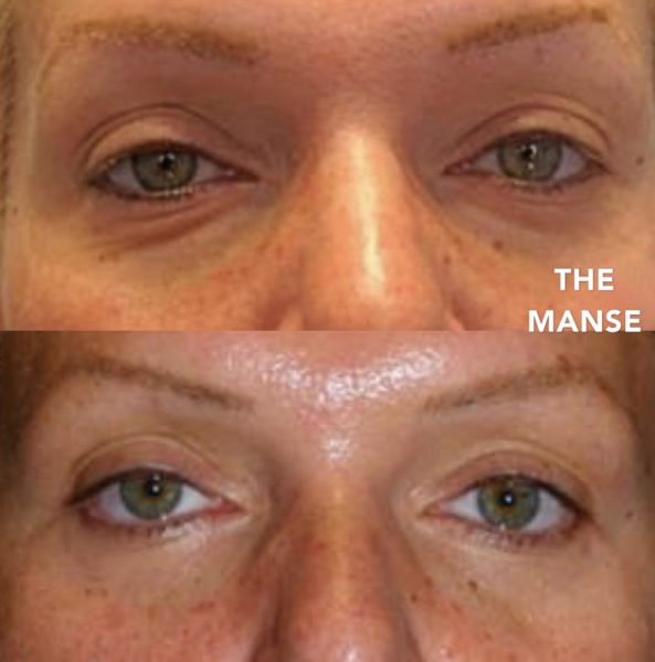 Tear trough treatments to reduce the appearance of eye bags or under eye hollowness. It is a very common treatment in our Sydney clinic