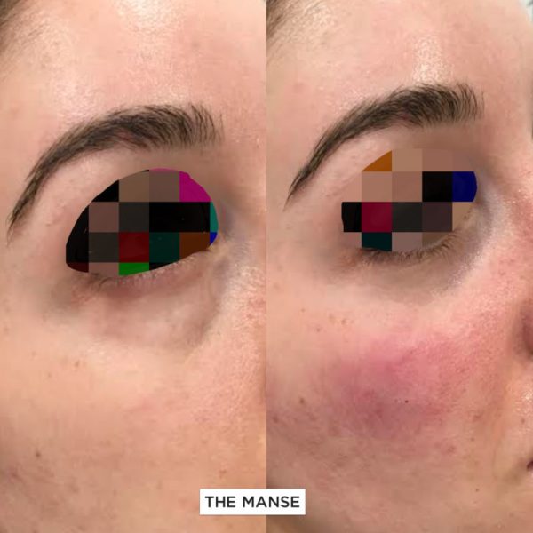 Tear troughs before and after