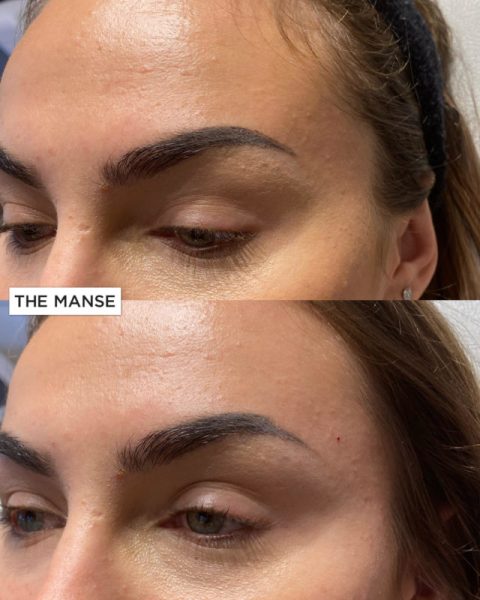 Temple treatment before and after