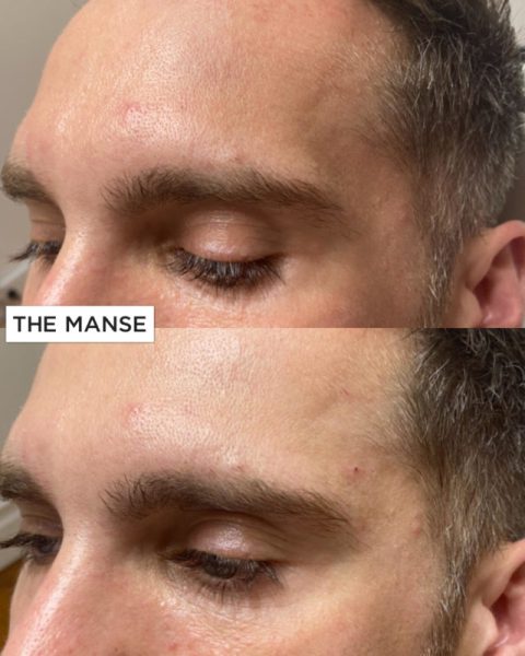 Temple treatment before and after