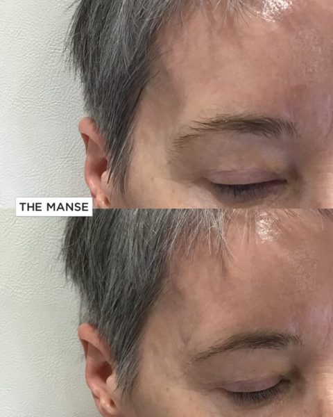 Temple treatments before and after Sydney