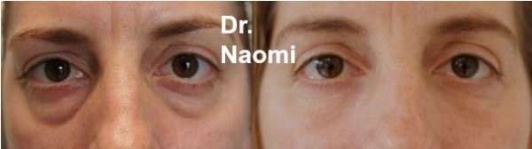 The after photo is 2 years and 5 months after the before photo (3 treatments were performed originally)