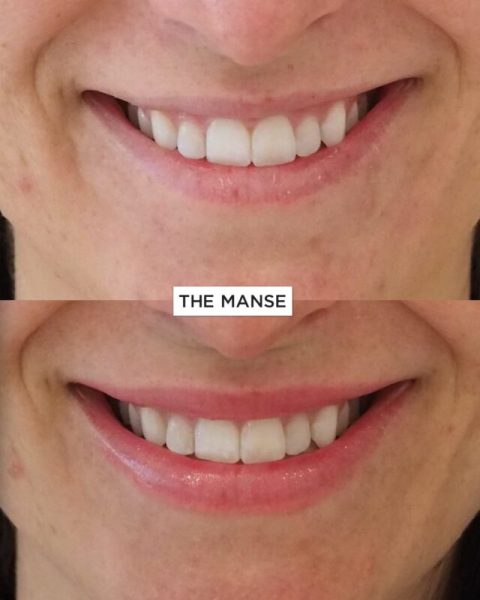 This patient wanted her upper lip to stop disappearing when she smiled