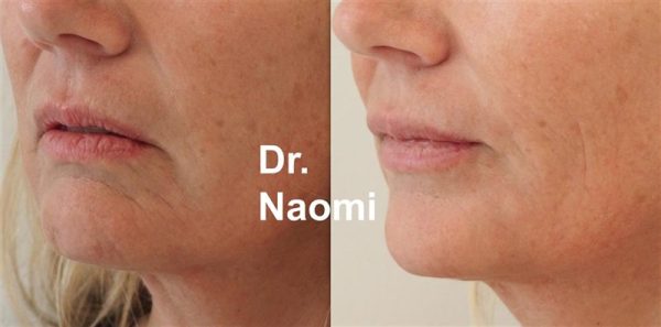 Treatment for ageing lips and chin